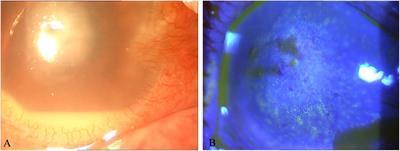 Cure of mycobacterium avium keratitis caused by trauma in elderly: case report